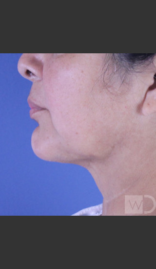 After Photo for SmartLipo Liposuction of Lower Face - Daniel Friedmann  - Prejuvenation