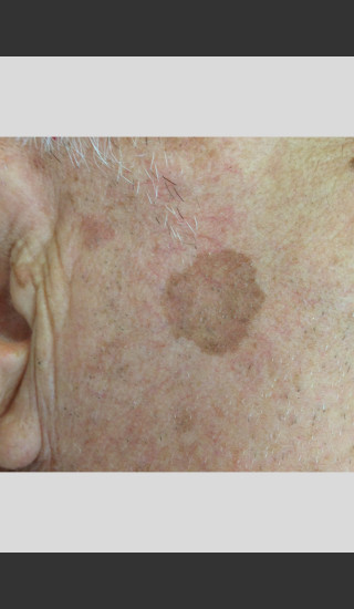 Before Photo for Elos - Facial Contouring & Wrinkles -  - Prejuvenation