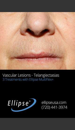After Photo for 3 Full Face Rejuvenation Treatments -  - Prejuvenation