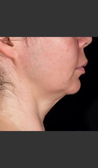 After Photo for SculpSure Submental - Bruce E Katz, M.D. - Prejuvenation