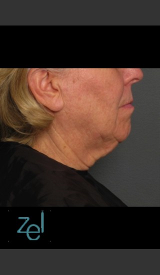 Before Photo for Treatment of Lower Face with Ultherapy - Brian D. Zelickson, M.D. - Prejuvenation