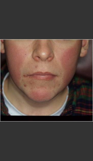 Before Photo for Rosacea treated by laser. - Christopher B. Zachary, MD - Prejuvenation