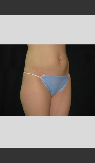 After Photo for Fat Cell Destruction Body Contouring -  - Prejuvenation