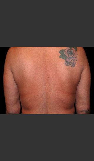 Before Photo for Body Contouring Treatment #113 -  - Prejuvenation