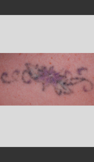 After Photo for PicoWay.Picosecond Technology Tattoo Removal -  - Prejuvenation