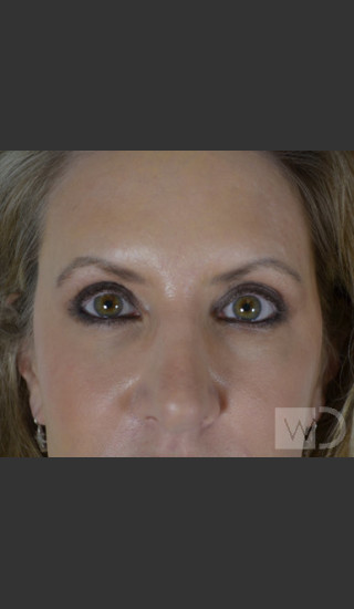 After Photo for Upper Blepharoplasty - Chuma Chike-Obi MD - Prejuvenation