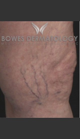 Before Photo for Spider Vein Treatment - Leyda Elizabeth Bowes, M.D. - Prejuvenation