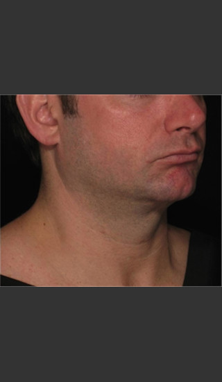 After Photo for Treatment of Neck with Laser Liposuction -  - Prejuvenation
