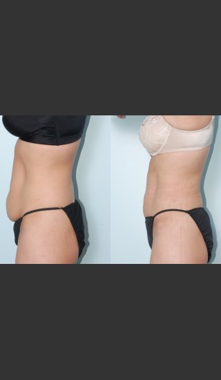 After Photo for Liposuction of waist, hips, thighs, and tummy. - Mark B. Taylor, M.D. - Prejuvenation
