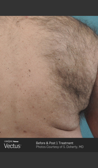 Before Photo for Hair Removal of Back with Vectus -  - Prejuvenation
