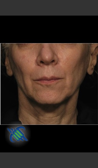 Before Photo for Treatment of Facial Laxity with Profound - Roy G. Geronemus, M.D. - Prejuvenation