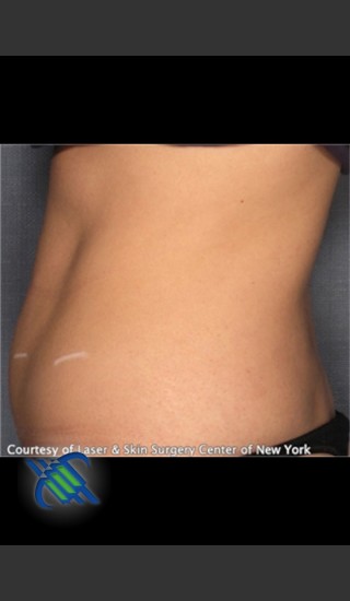 Before Photo for CoolSculpting Treatment of Lower Abdomen Side On - Roy G. Geronemus, M.D. - Prejuvenation