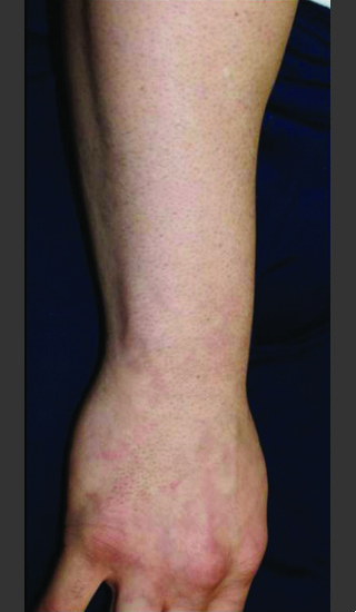 After Photo for Quanta Q-Plus C Laser Tattoo Removal #70 -  - Prejuvenation