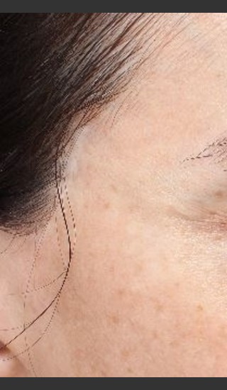 After Photo for Scar on right and left temple at hairline  - Paul M. Friedman, M.D. - Prejuvenation