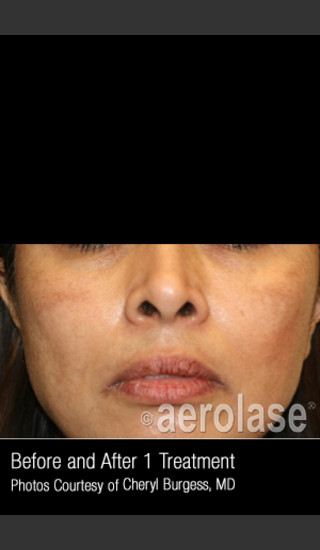 After Photo for Treatment of Melasma #318 -  - Prejuvenation