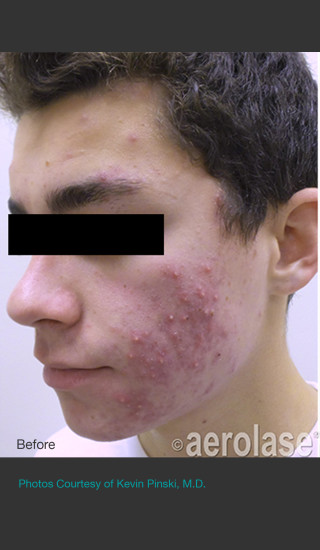 Before Photo for NeoClear by Aerolase Acne Treatment -  - Prejuvenation