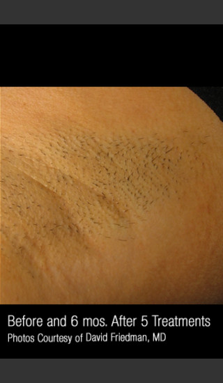 Before Photo for Hair Removal #311 -  - Prejuvenation