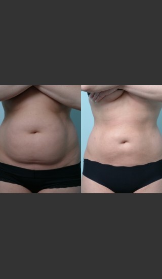 Before Photo for Liposuction - Mark B. Taylor, M.D. - Prejuvenation