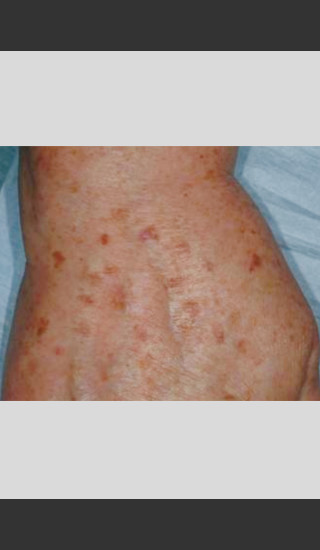 Before Photo for Vbeam Laser Treatment of Pigmentation -  - Prejuvenation