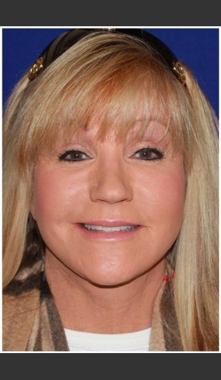 After Photo for Facelift - Case 30 - Konstantin Vasyukevich, MD - Prejuvenation