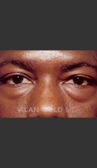 Before Photo for Blepharoplasty 1027 - Alan Gold MD - Prejuvenation