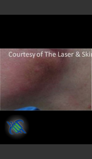 Before Photo for Treatment of Bruising - Roy G. Geronemus, M.D. - Prejuvenation