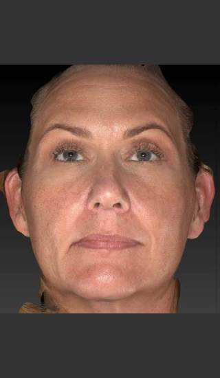 Before Photo for Sun Damage Reduction - Douglas Wu, M.D. - Prejuvenation