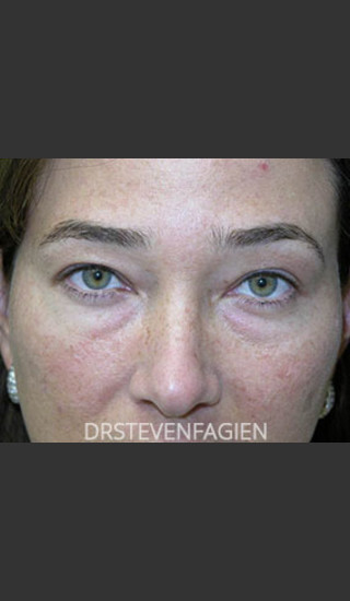 Before Photo for Upper and Lower Blepharoplasty - Patient 6 - Steven Fagien, MD - Prejuvenation