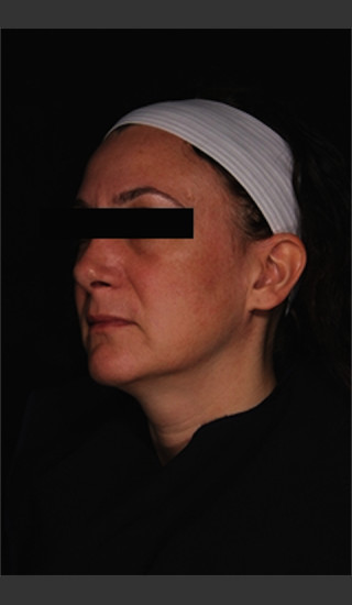After Photo for Treatment of Melasma -  - Prejuvenation