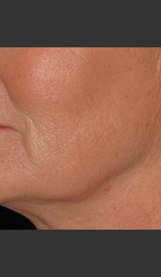 After Photo for Infini Rhytides Treatment #16 -  - Prejuvenation