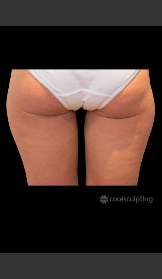 After Photo for CoolSculpting on Woman's Inner Thigh -  - Prejuvenation