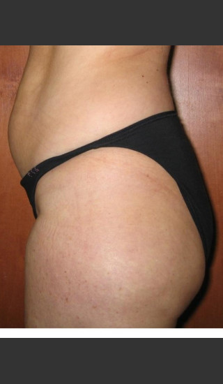 After Photo for 3DEEP Lower Body Cellulite Reduction -  - Prejuvenation
