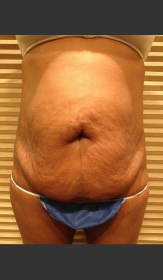 Before Photo for Dr. Palmer Tummy Tuck 01  - Shane Palmer - Prejuvenation