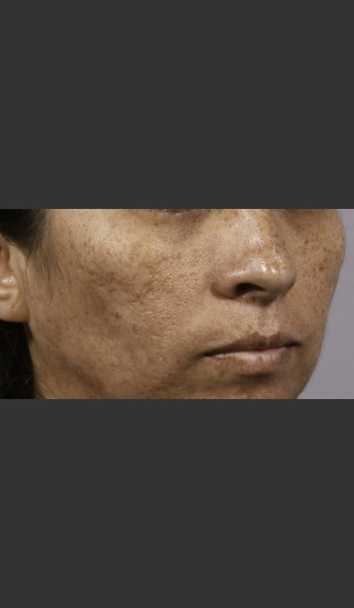 Before Photo for 3DEEP Intensif Microneedling #1 -  - Prejuvenation