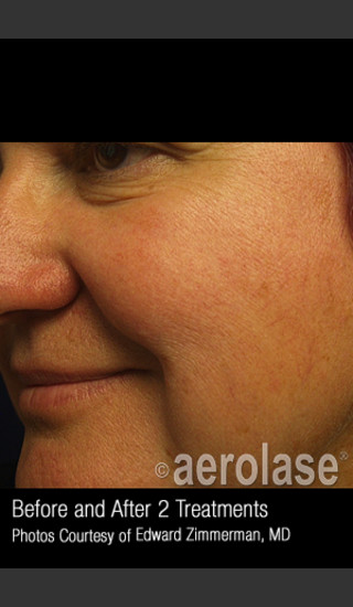 After Photo for Treatment of Facial Blood Vessels #323 -  - Prejuvenation