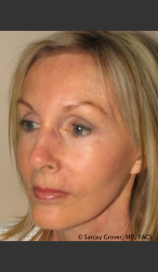 After Photo for Facelift Case 6944 - Sanjay Grover MD FACS - Prejuvenation