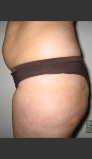Before Photo for 3DEEP Lower Body Cellulite Reduction -  - Prejuvenation