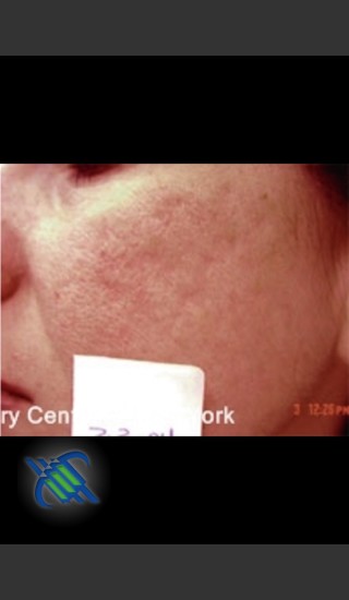 After Photo for Treatment of Facial  Acne Scars Left Side - Roy G. Geronemus, M.D. - Prejuvenation