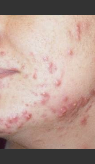 Before Photo for Quanta Eterna IPL Acne Treatment #79 -  - Prejuvenation