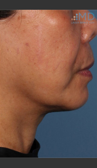 After Photo for Ultherapy Skin Laxity Treatment of Lower Face - Margaret Ann Weiss - Prejuvenation