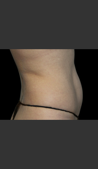After Photo for Body Contouring Treatment #118 -  - Prejuvenation