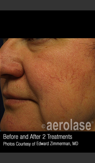Before Photo for Treatment of Facial Blood Vessels #323 -  - Prejuvenation