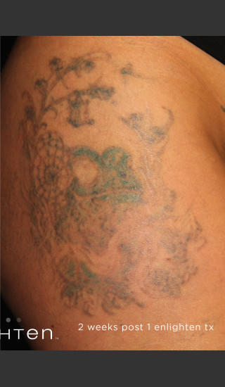 After Photo for Large Green Tattoo Removel Before & After Photo -  - Prejuvenation
