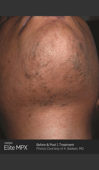 After Photo for Hair Removal on Chin with Elite MPX -  - Prejuvenation