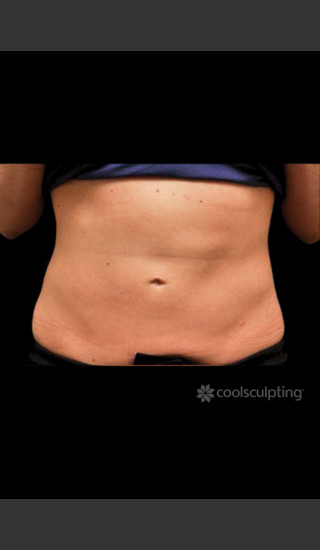 After Photo for CoolSculpting on Woman's Lower Abdomen -  - Prejuvenation