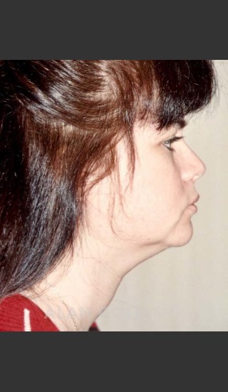 Before Photo for Liposuction of Neck 96 Side View - Alan Gold MD - Prejuvenation