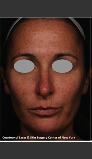 Before Photo for Treatment of Facial Pigmentation -  - Prejuvenation