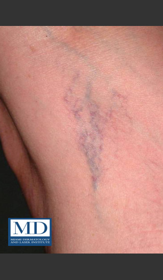 Before Photo for Sclerotherapy Treatment 140 - Jill S. Waibel, MD - Prejuvenation