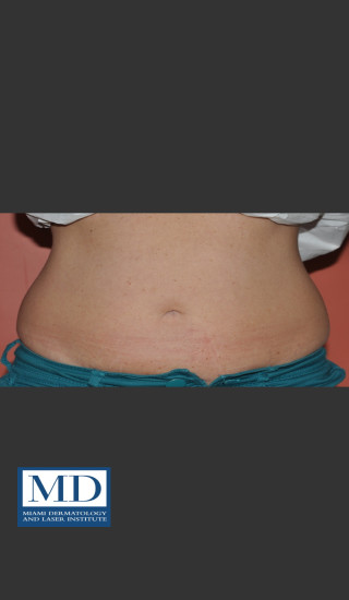 Before Photo for  Body Contouring Treatment 143 - Jill S. Waibel, MD - Prejuvenation