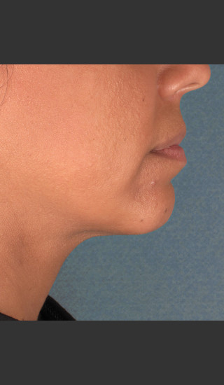After Photo for Kybella Treatment 34 Year Old Female -  - Prejuvenation